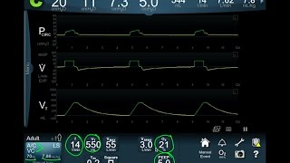 Vent Modes 101 Focus on the Waveform  BAVLS [upl. by Naaitsirhc907]