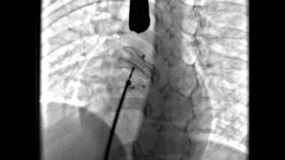 Septal Occluder release across the ASD [upl. by Assej738]