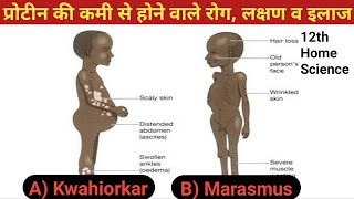 प्रोटीन की कमी से होने वाले रोग लक्षण व इलाज  Kwashiorkor disease  Marasmus disease [upl. by Elleivap]