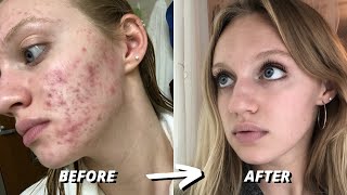 HOW I CLEARED 7 YEARS OF SEVERE ACNE  ACCUTANE JOURNEY [upl. by Rabka]