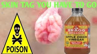 How To Remove A Skin Tag Using Apple Cider Vinegar [upl. by Aliled]