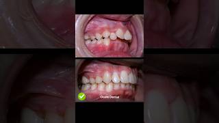 Braces overbite treatment braces orthodontist dentist dental [upl. by Eisdnil116]