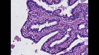 Histopathology BreastIntraductal papilloma [upl. by Ibbetson670]