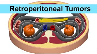 Retroperitoneal Tumors by ASM Minds Team [upl. by Ynnelg]