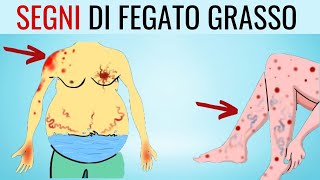 MINACCIA SILENZIOSA 8 SEGNI che POSSONO indicare una malattia del FEGATO GRASSO [upl. by Pasahow]