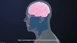 Transport of βamyloid from brain to eye causes retinal degeneration in Alzheimer’s disease [upl. by Nawek]