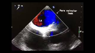 Para valvular leak a hardly visible complication to drahmadmirdamadisiv6SmM2QAJUsu7NS [upl. by Las]