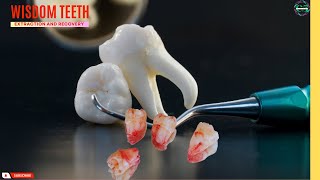 Wisdom Teeth Extraction  Surgical removal and recovery wisdomteeth dentist health [upl. by Acim721]