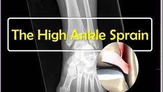 The High Ankle Sprain [upl. by Fezoj769]