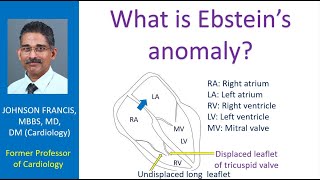 What is Ebstein’s anomaly [upl. by Eelrefinnej]