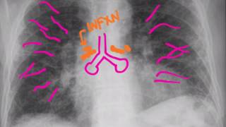 CXR Pneumonias [upl. by Akimet681]