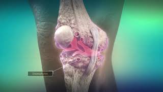 Sports Injuries sportsinjuryrehab osteoarthritis [upl. by Jea]