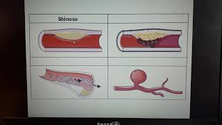 1ST2S Vidéo 5 lathérosclérose [upl. by Ahtel]
