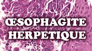 L’OESOPHAGITE HERPETIQUE  PATHOLOGIE [upl. by Lebana]