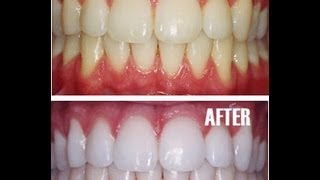 Teeth Whitening at Home with Baking Soda  Amazing Results [upl. by Anauqed713]