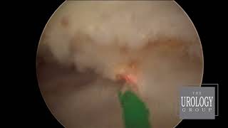 Holmium Laser Enucleation of the Prostate HOLEP [upl. by Zat575]