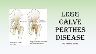 Perthes disease  clinical features investigation Waldenstrom staging Herring classification [upl. by Meece]