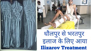 TIBIA FIBULA OPEN FRACTURE ILIZAROV TREATMENT ilizarovsurgery fracture [upl. by Auston]