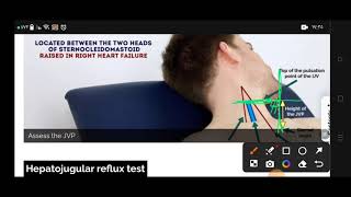 jugular venous pressure osce inspect neck veins [upl. by Popelka]