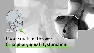 Cricopharyngeal Dysfunction Before and After Cricopharyngeal Myotomy [upl. by Adnarem]