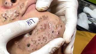 Big Cystic Acne Blackheads Extraction Blackheads amp Milia Whiteheads Removal Pimple Popping  4560 [upl. by Eenafets74]