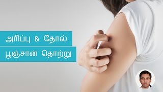 Skin Fungal Infections Symptoms Causes Treatments  Tamil [upl. by Mishaan70]