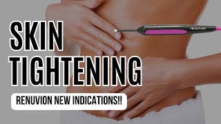 New Indications for Renuvion Device  Skin Tightening Procedure [upl. by Liv]