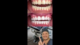 Aprenda a Clarear os Dentes em Casa [upl. by Titania160]