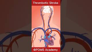 Stroke  Ischemic stroke pathology disease [upl. by Hilly]