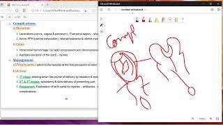 د السكري Precipitate labor amp inertia [upl. by Anaitit]