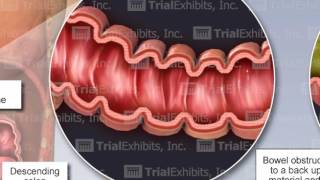 Bowel Perforation [upl. by Alleb]