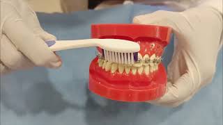 Brushing Technique for Orthodontic Patients English [upl. by Meehahs]