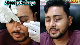 Abscess Pus Drainage A Medical Case Study Eye Abscess Treatment [upl. by Zaid]