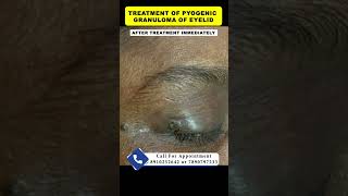 Treatment of pyogenic granuloma  By Dr Uttam Kumar Lenka MBBS MD Consultant Dermatologist [upl. by Neelrahs]