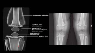 SCURVY VS RICKETS RADIOLOGY [upl. by Ardnekahs]