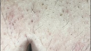 Ingrown back hairs part 12 [upl. by Aeriel]