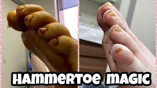 MINIMALLY INVASIVE HAMMERTOE SURGERY LIVE PROCEDURES 😍 [upl. by Conroy830]