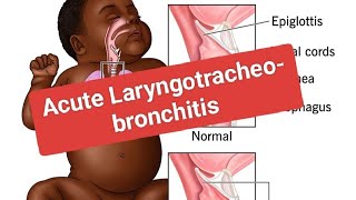 Croup Acute Laryngotracheitis  Acute Laryngotracheobronchitis [upl. by Refotsirk]