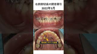 前歯が生えてこない子供の矯正治療 歯医者 矯正歯科 dentist [upl. by Uttasta154]