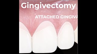 Esthetic Gingival Recontouring after Orthodontic Treatment [upl. by Nelleus]