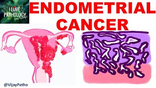 ENDOMETRIAL CARCINOMA Risk factors Etiopathogenesis Morphology amp Clinical features [upl. by Kabob]