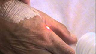 Erbium Laser Facial Neck Declete Hand and Arm Resurfacing [upl. by Lucania804]