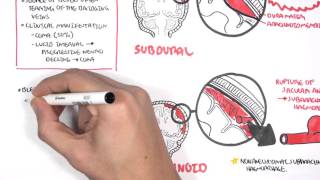 Intracranial hemorrhage  intracerebral vs extracerebral extradural subdural subarachnoid [upl. by Francis]