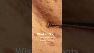 Technically called Seborrheic Keratosis shorts skintreatment skingrowth moleremoval agespot [upl. by Orvah]