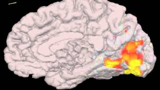 El aura de la migraña vista con resonancia funcional [upl. by Colene]