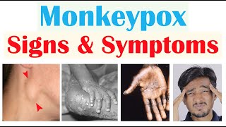 Monkeypox Signs amp Symptoms First Symptom amp Stages of Rash [upl. by Mackie]