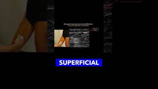 Identifying the Great Saphenous Vein vascularultrasound healthcareexcellence MedicalEducation [upl. by Hamford]