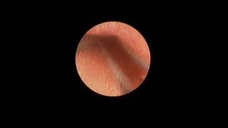 Ureteroscopy and Laser Lithotripsy for Treatment of Ureteral Stones [upl. by Irahc728]