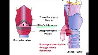 ESOPHAGEAL DIVERTICULUM [upl. by Sawyer407]