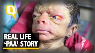 The Quint Progeria Child In Bangladesh [upl. by Pinto987]